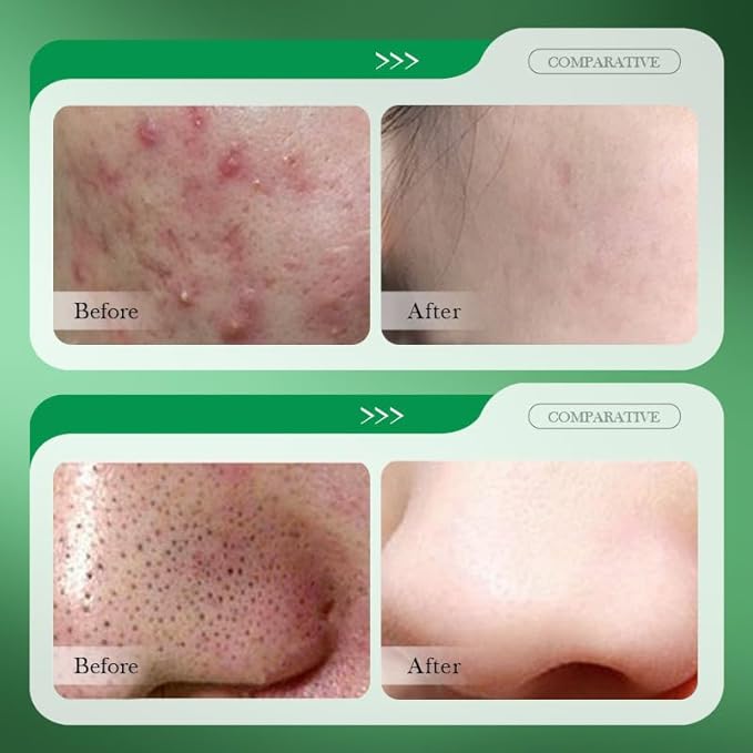 1 PC Salicylic Acid Cotton Pads Salicylic Acid Mask, Purifying Oil Control Deep Cleansing Soothing Mask For Face, 110g