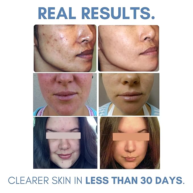 Clarifying Toner for Acne and Blemishes, Face Toner, Facial Toner, Skin Toner, Acne Toner, Toner Oily Skin, Salicylic Acid Toner, Astringent for Face, Toners, 4 Fl Oz-VeraVaultWomen