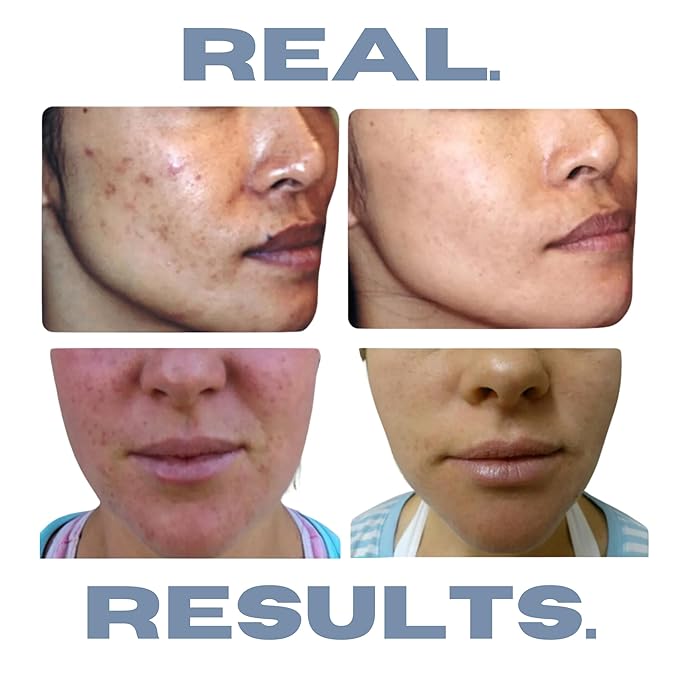 Clarifying Toner for Acne and Blemishes, Face Toner, Facial Toner, Skin Toner, Acne Toner, Toner Oily Skin, Salicylic Acid Toner, Astringent for Face, Toners, 4 Fl Oz-VeraVaultWomen